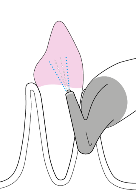 AirFlow - Oberhalb der Zahnschmelz-Zementgrenze