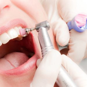 Professionelle Zahnreinigung Kariestest
